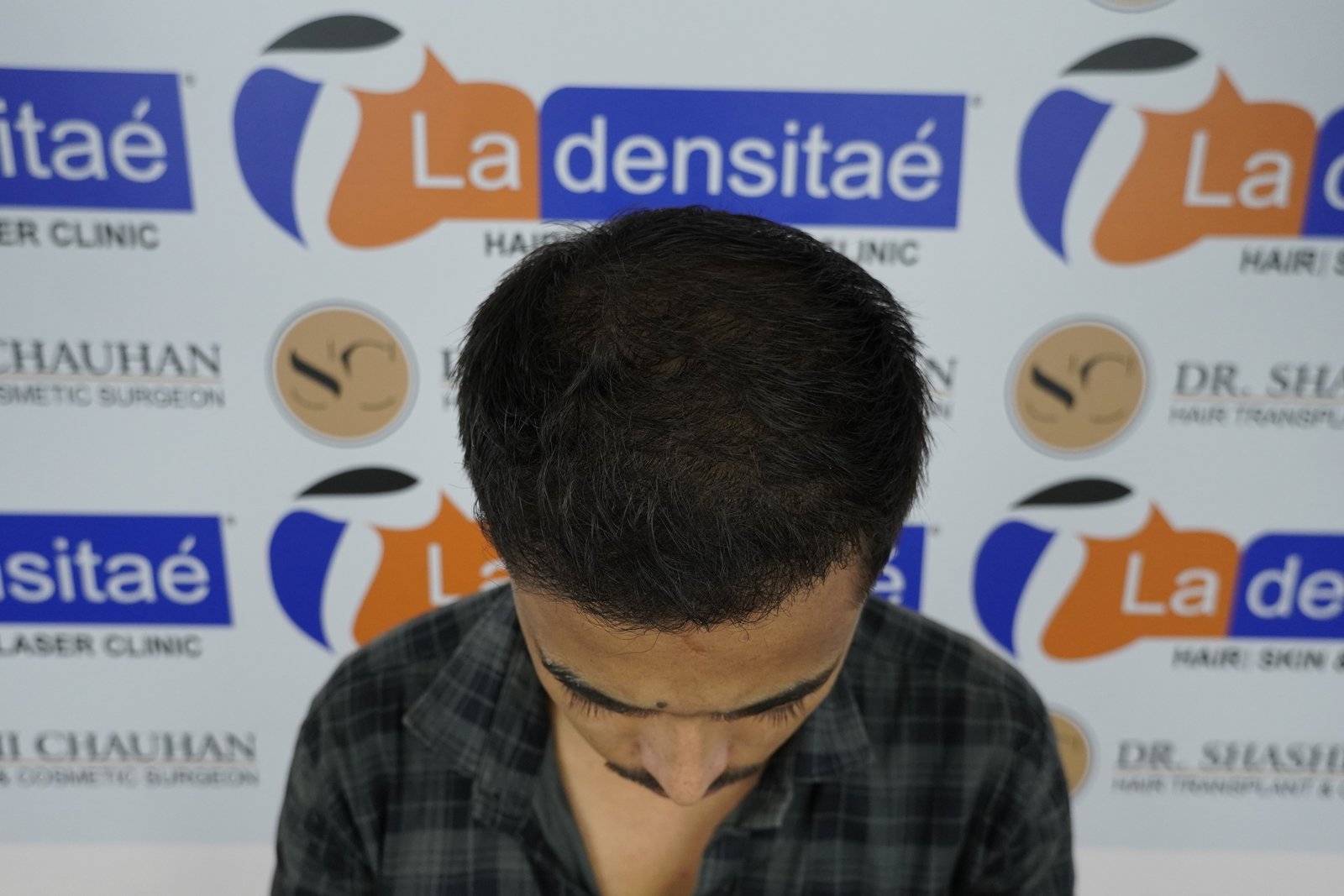 Ashis Yadav After Hair Transplant